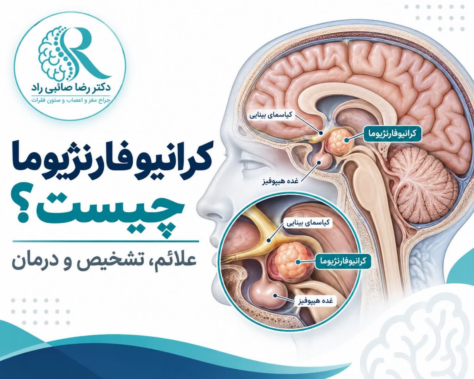 اینفوگرافی به زبان فارسی درباره کرانیوفارنژیوما تومور مغزی نزدیک غده هیپوفیز و هیپوتالاموس