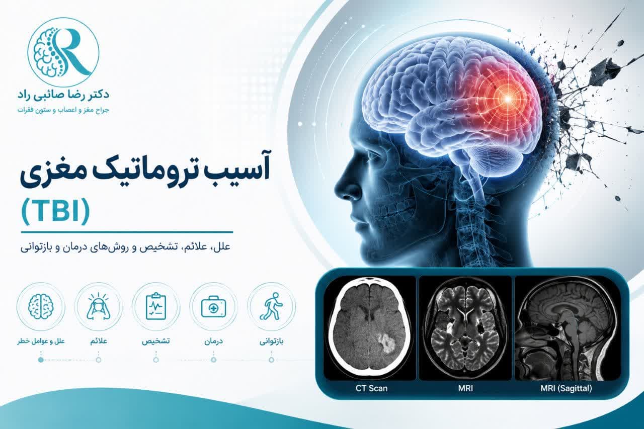 تصویر سه‌بعدی پزشکی از آسیب تروماتیک مغزی (TBI) با نمایش خونریزی و تورم مغز داخل جمجمه