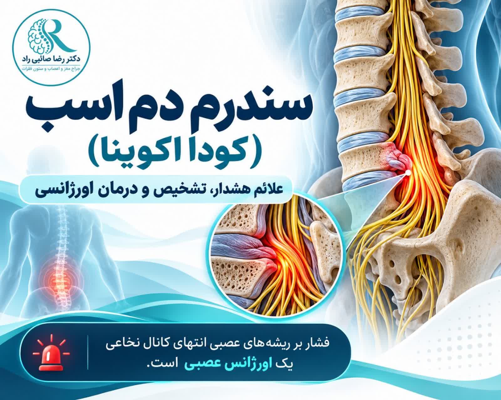 سندروم کودا اکوینا یا دم اسب و فشار بر ریشه‌های عصبی انتهای ستون فقرات