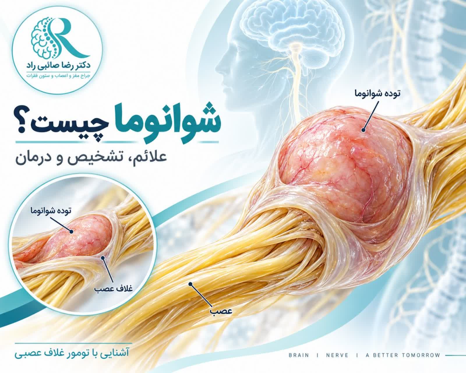شوانوما یا تومور خوش خیم غلاف عصب و انواع شوانوم وستیبولار و نخاعی