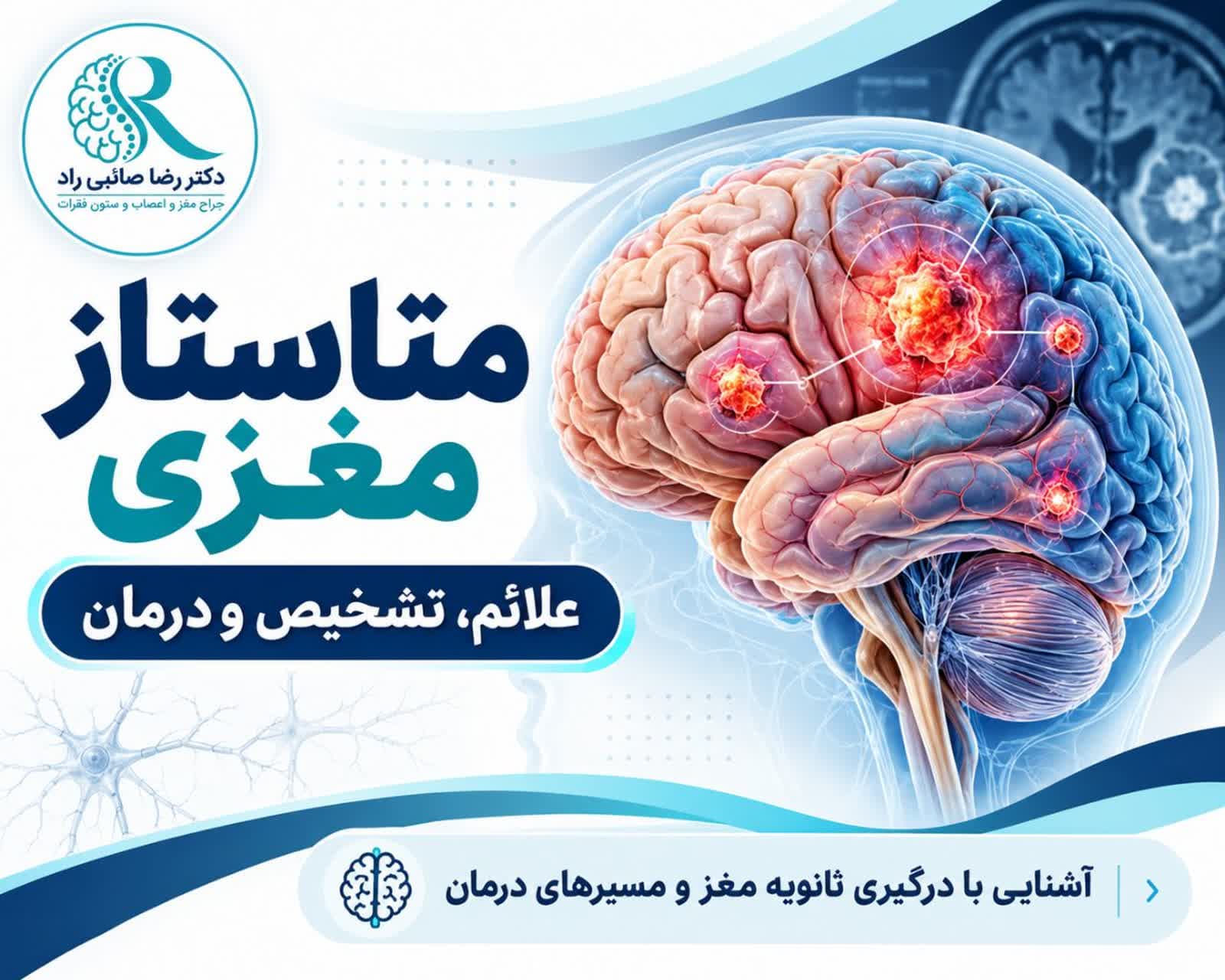 تصویر آموزشی متاستاز مغزی، محل ضایعات و گسترش سرطان به مغز