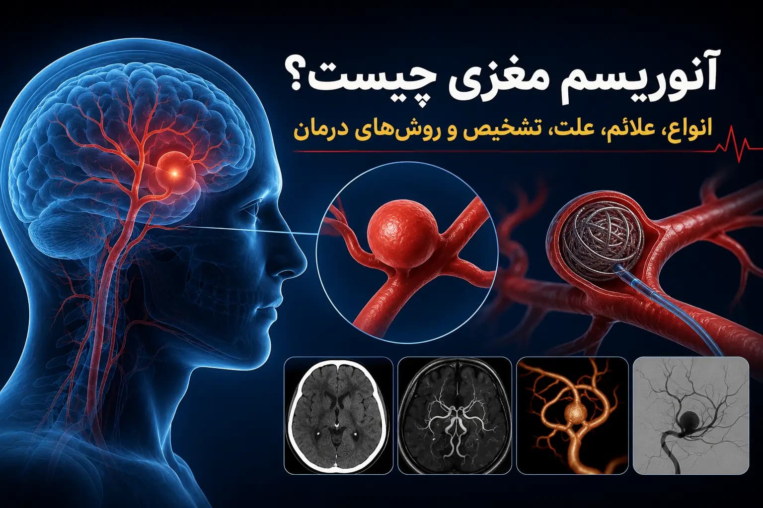 تصویر شماتیک انواع آنوریسم مغزی و محل ایجاد آن در شریان‌های مغز