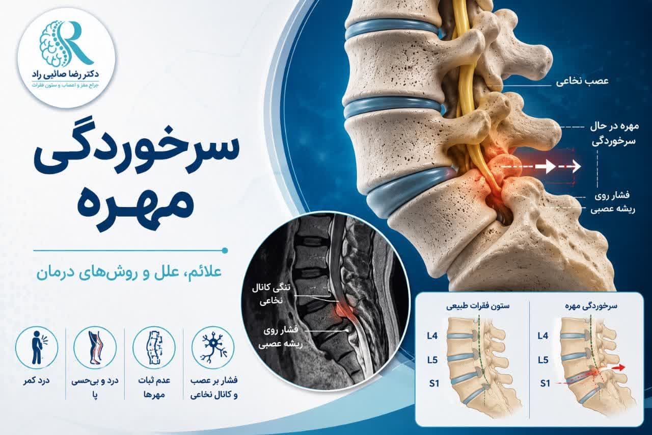 سرخوردگی مهره چیست؟ علائم، درجات، تشخیص و روش‌های درمان