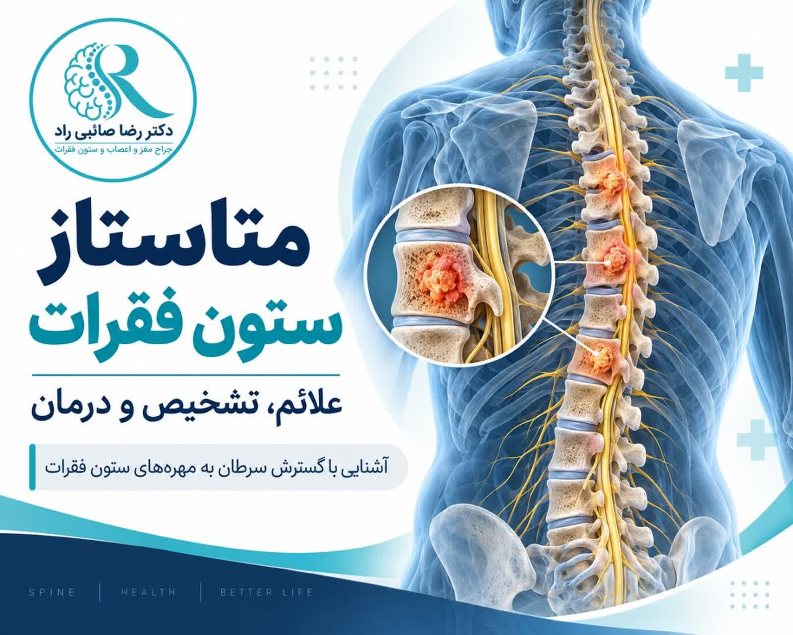 متاستاز ستون فقرات و انتشار سلولهای سرطانی به مهرهها همراه با فشار بر نخاع